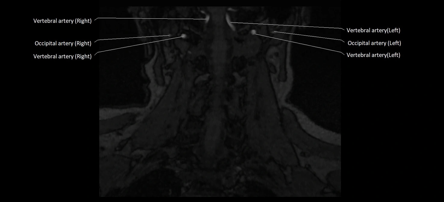 MRA carotid artery anatomy cross sectional 3T coronal image 15.webp